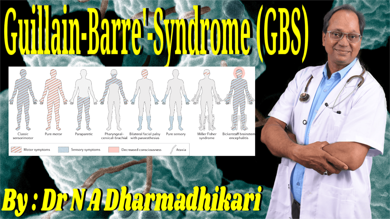 Guillain-Barré Syndrome GBS – A Comprehensive Guide For Everyone Guillain-Barré Syndrome awareness template image for medical education and patient information